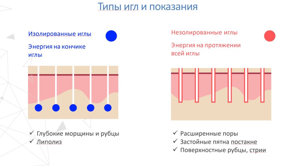Vivace — Fractional Micro Needle RF